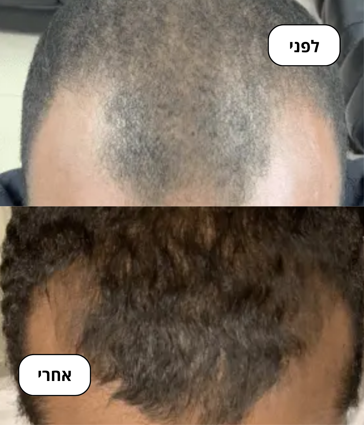 השילוב בין טכנולוגיה מתקדמת, טיפול עדין ותוצאות מהירות הופך את Sparker™ לבחירה המובילה למי שמחפש פתרון אמיתי, יעיל וארוך טווח לנשירת שיער.